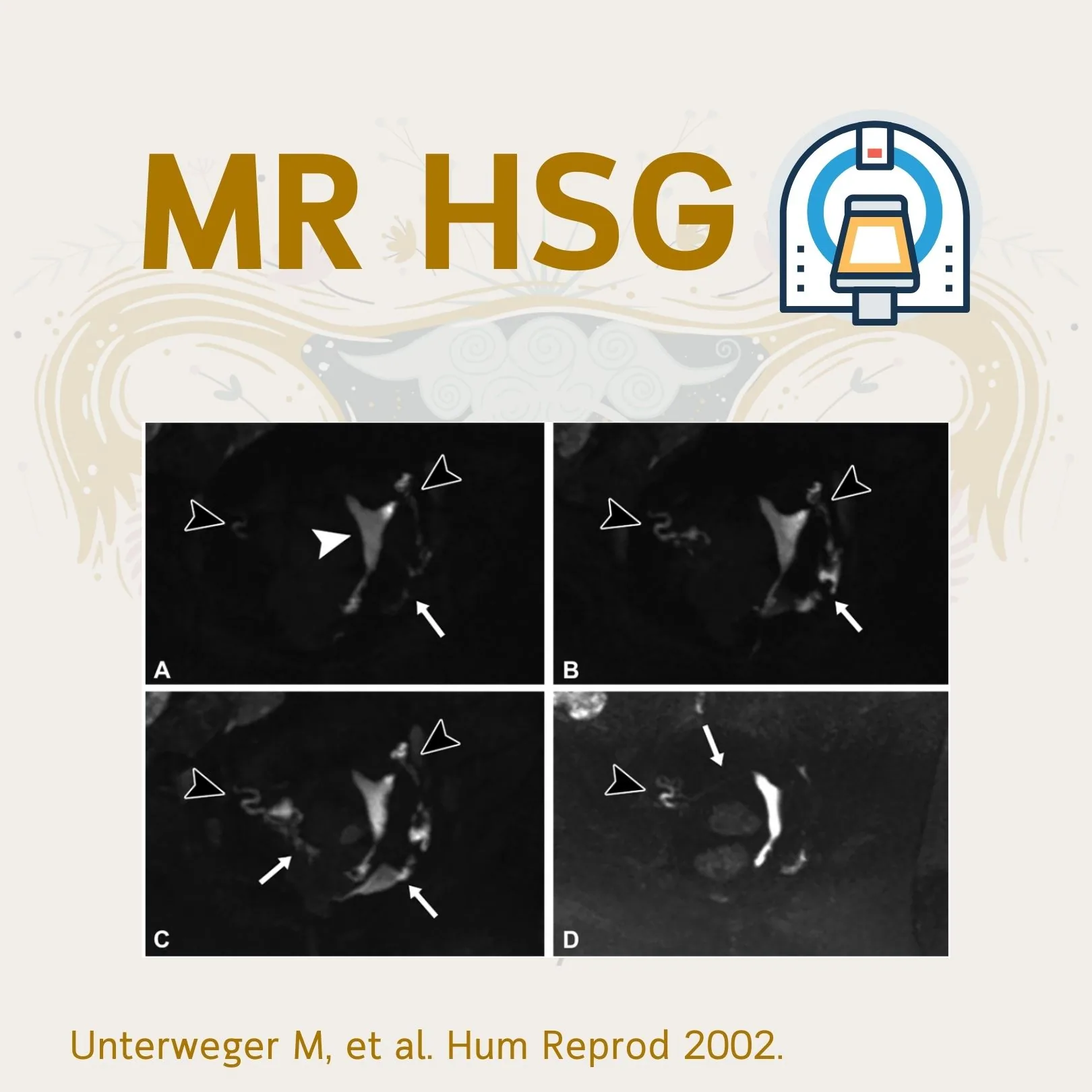 MR HSG images showing the uterine cavity and the tubes in panels A–D (Unterweger M, et al. Hum Reprod 2002)