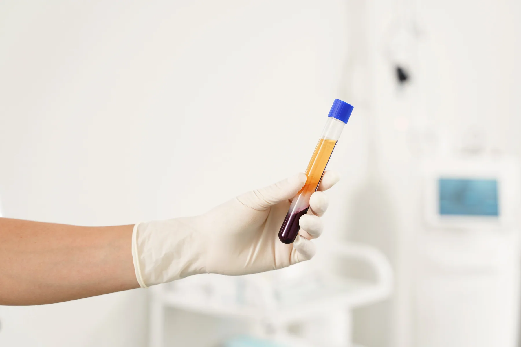 Ovarian PRP 3.0