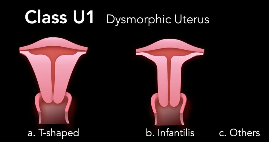 Dysmorphic uterus