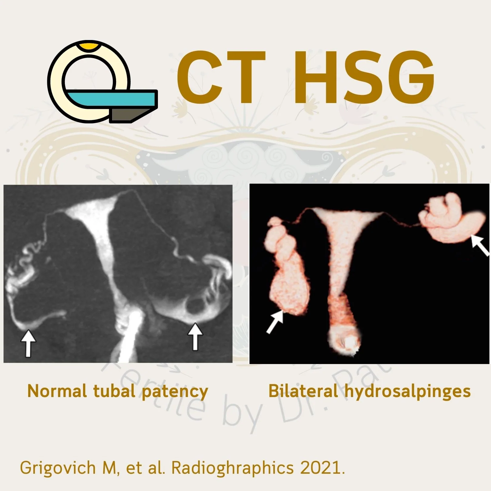 CT HSG images: normal tubal patency on the left, bilateral hydrosalpinges on the right (Grigovich M, et al. Radiographics 2021)