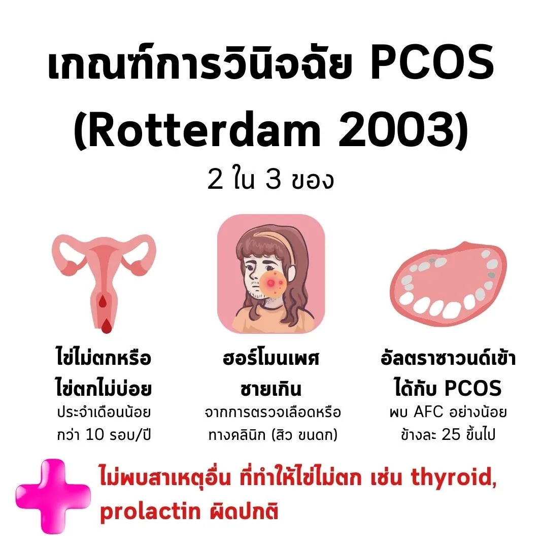 เกณฑ์การวินิจฉัย PCOS ตาม Rotterdam 2003 ต้องเข้าได้ 2 ใน 3 ข้อ คือ ไข่ไม่ตกหรือไข่ตกไม่บ่อย ฮอร์โมนเพศชายเกิน และอัลตราซาวนด์เข้าได้กับ PCOS โดยต้องไม่พบสาเหตุอื่นที่ทำให้ไข่ไม่ตก