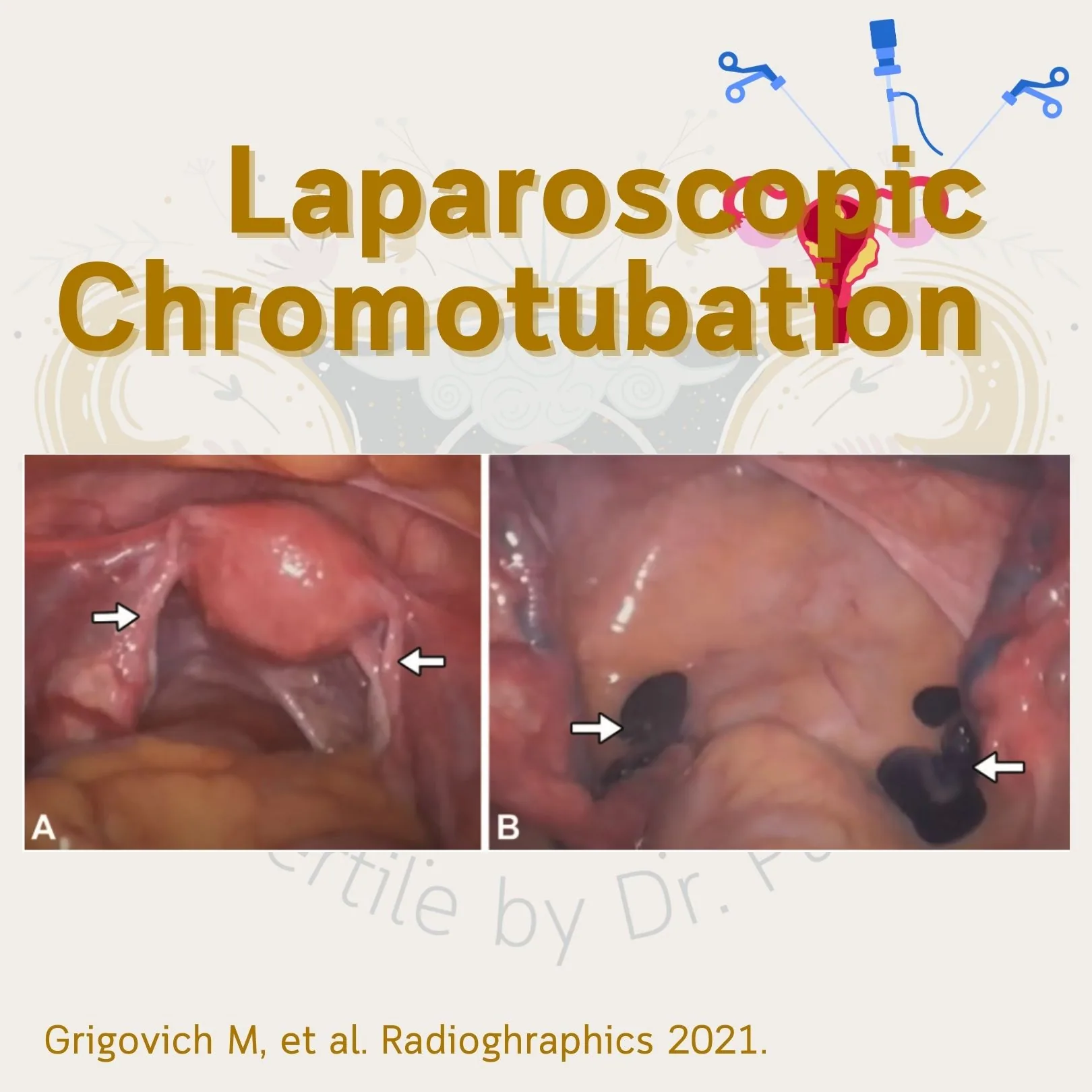 Laparoscopic chromotubation: the arrows point to both fallopian tubes, and in panel B the dye can be seen coming out of the ends of the tubes (Grigovich M, et al. Radiographics 2021)