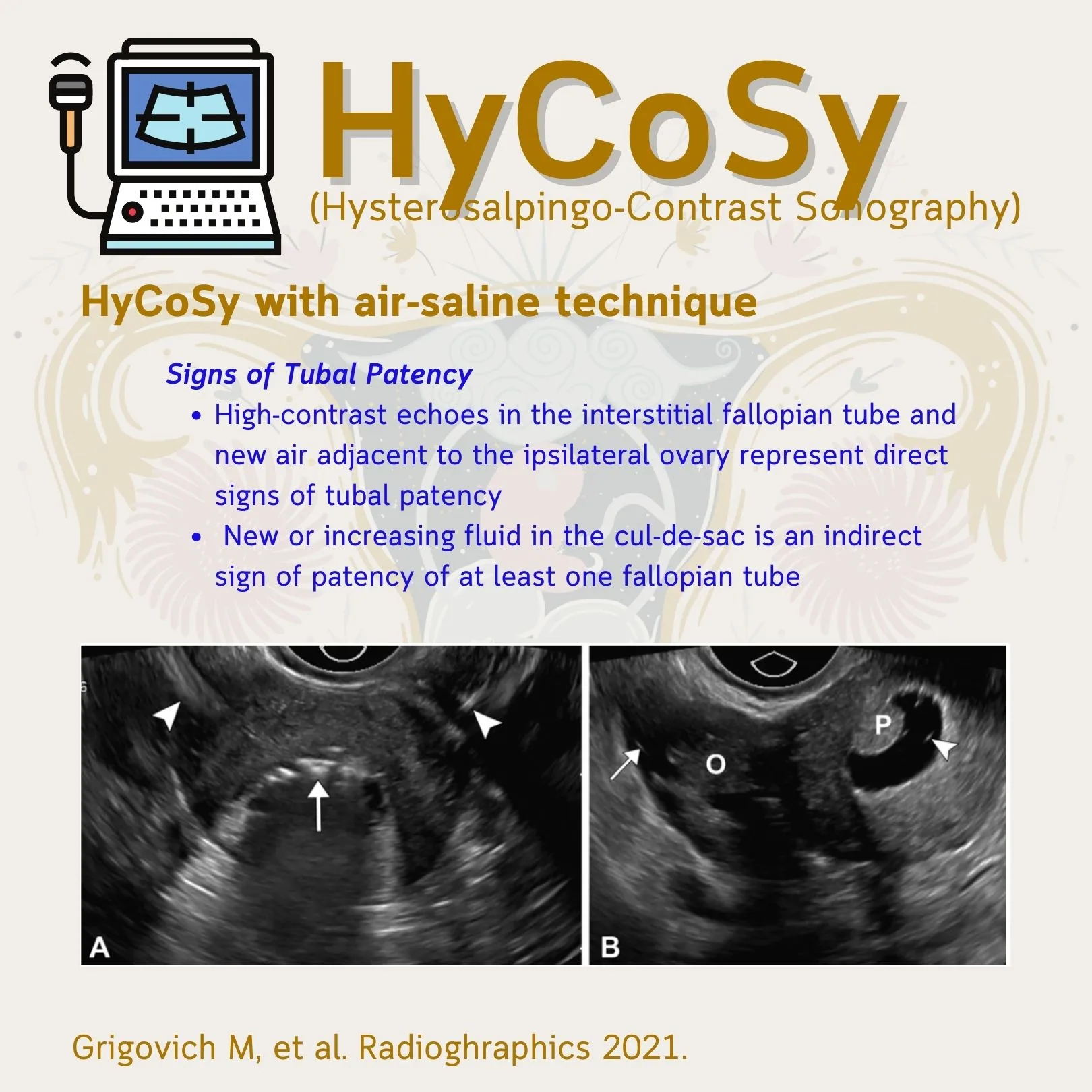 The HyCoSy slide, air-saline technique, with the signs of tubal patency and the accompanying ultrasound images (Grigovich M, et al. Radiographics 2021)