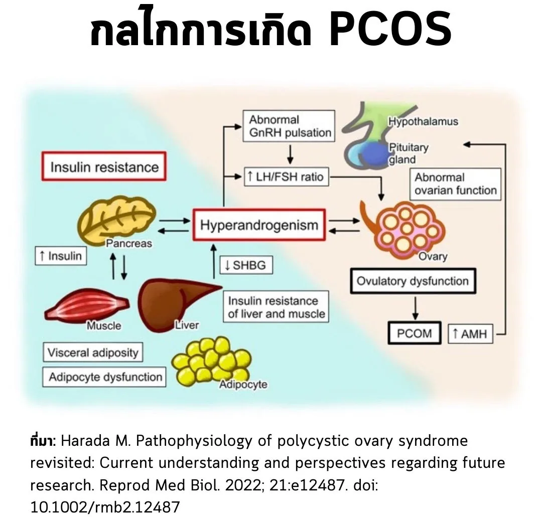 แผนภาพกลไกการเกิด PCOS ที่มา: Harada M. Pathophysiology of polycystic ovary syndrome revisited: Current understanding and perspectives regarding future research. Reprod Med Biol. 2022; 21:e12487. doi: 10.1002/rmb2.12487