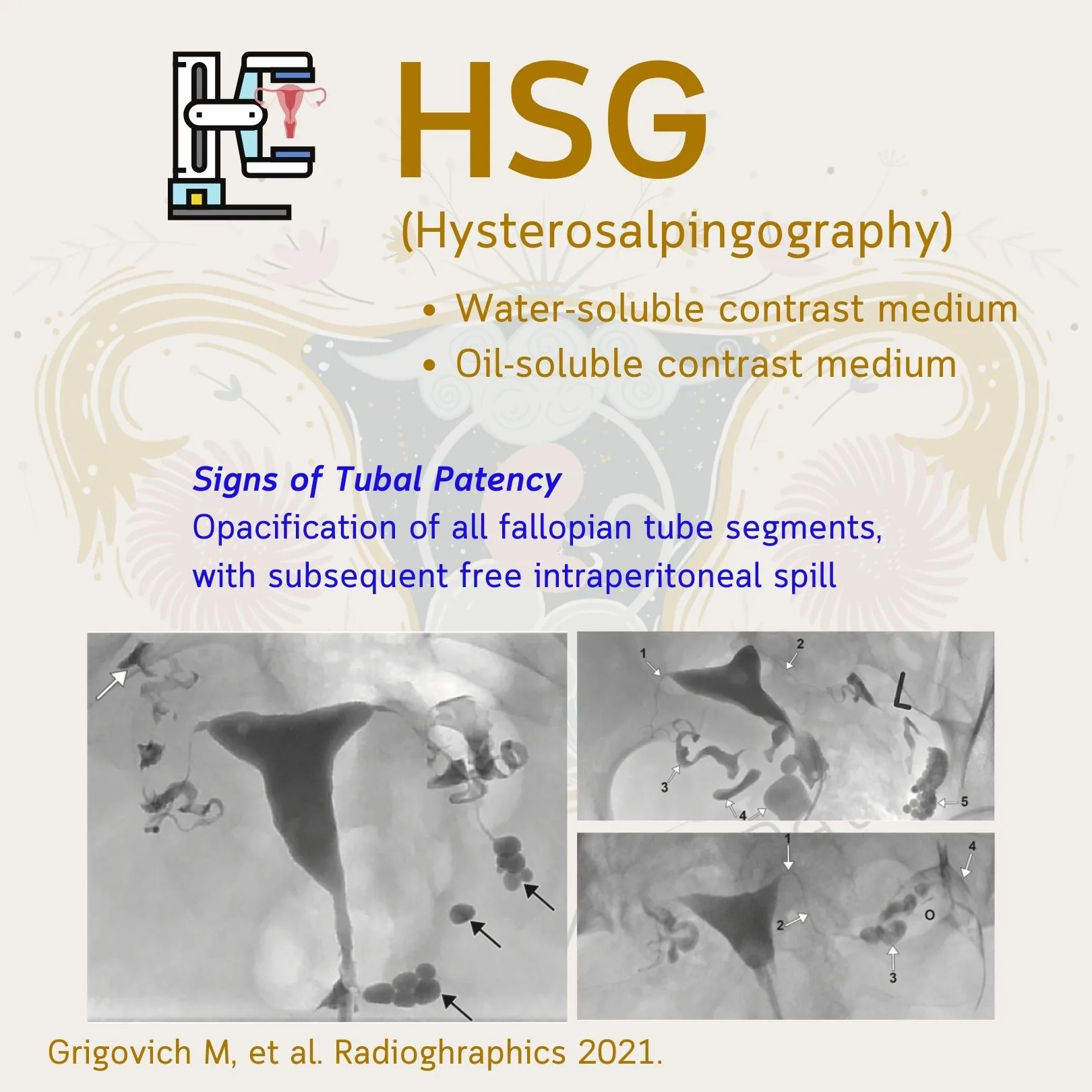 The HSG (hysterosalpingography) slide: the types of contrast medium, the sign of tubal patency, and X-ray images showing contrast running through the tubes and spilling into the abdomen (Grigovich M, et al. Radiographics 2021)