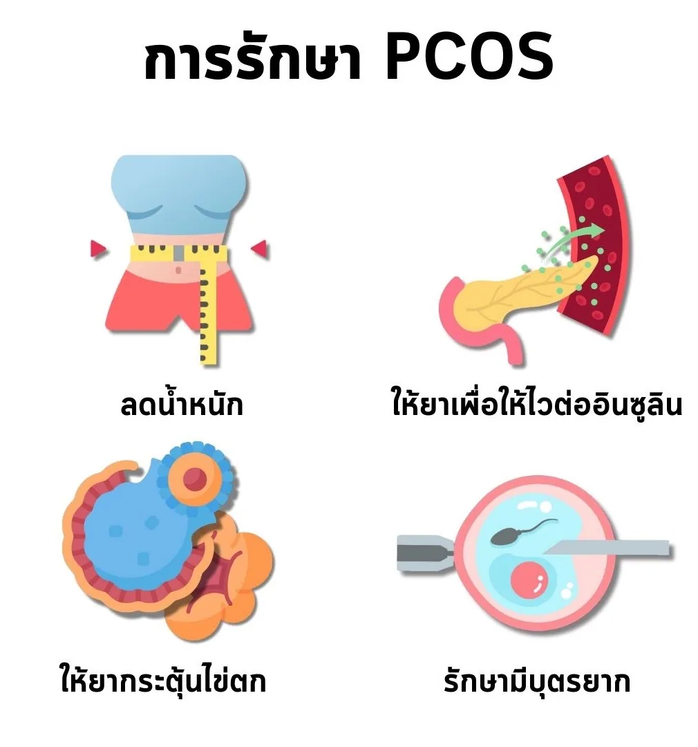 การรักษา PCOS ได้แก่ ลดน้ำหนัก ให้ยาเพื่อให้ไวต่ออินซูลิน ให้ยากระตุ้นไข่ตก และรักษามีบุตรยาก