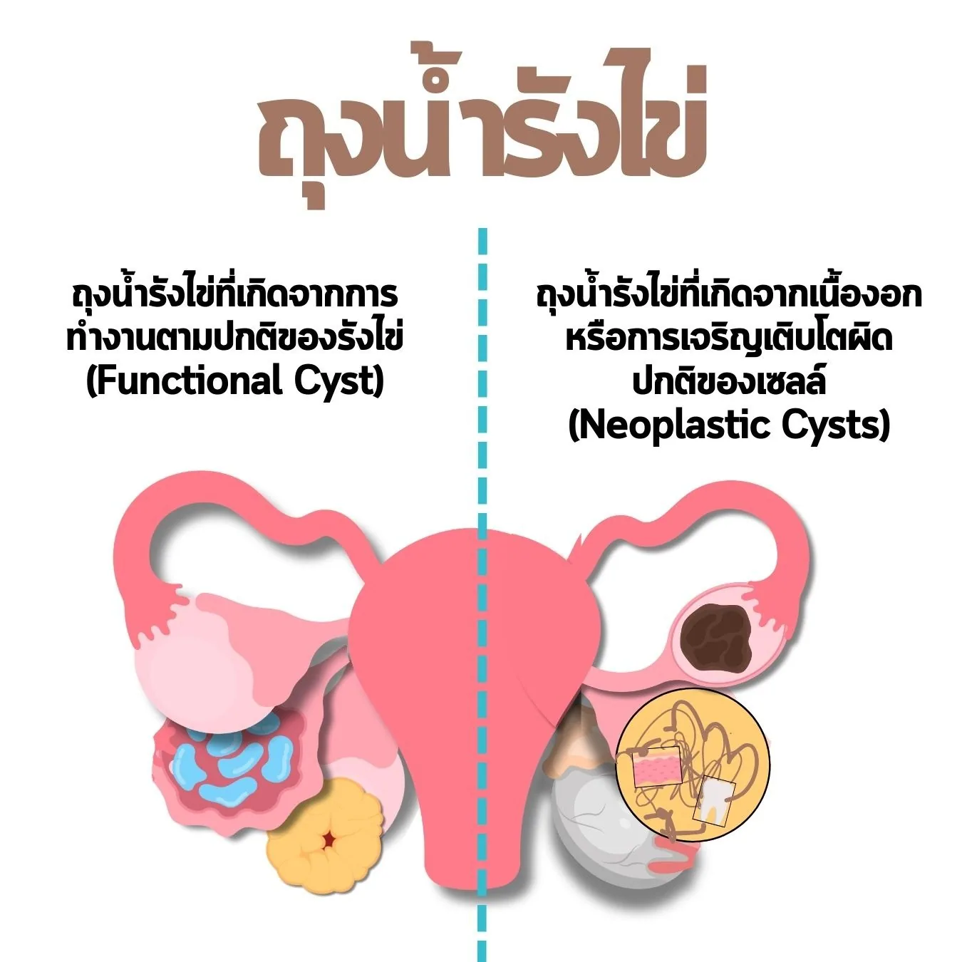 Ovarian cysts