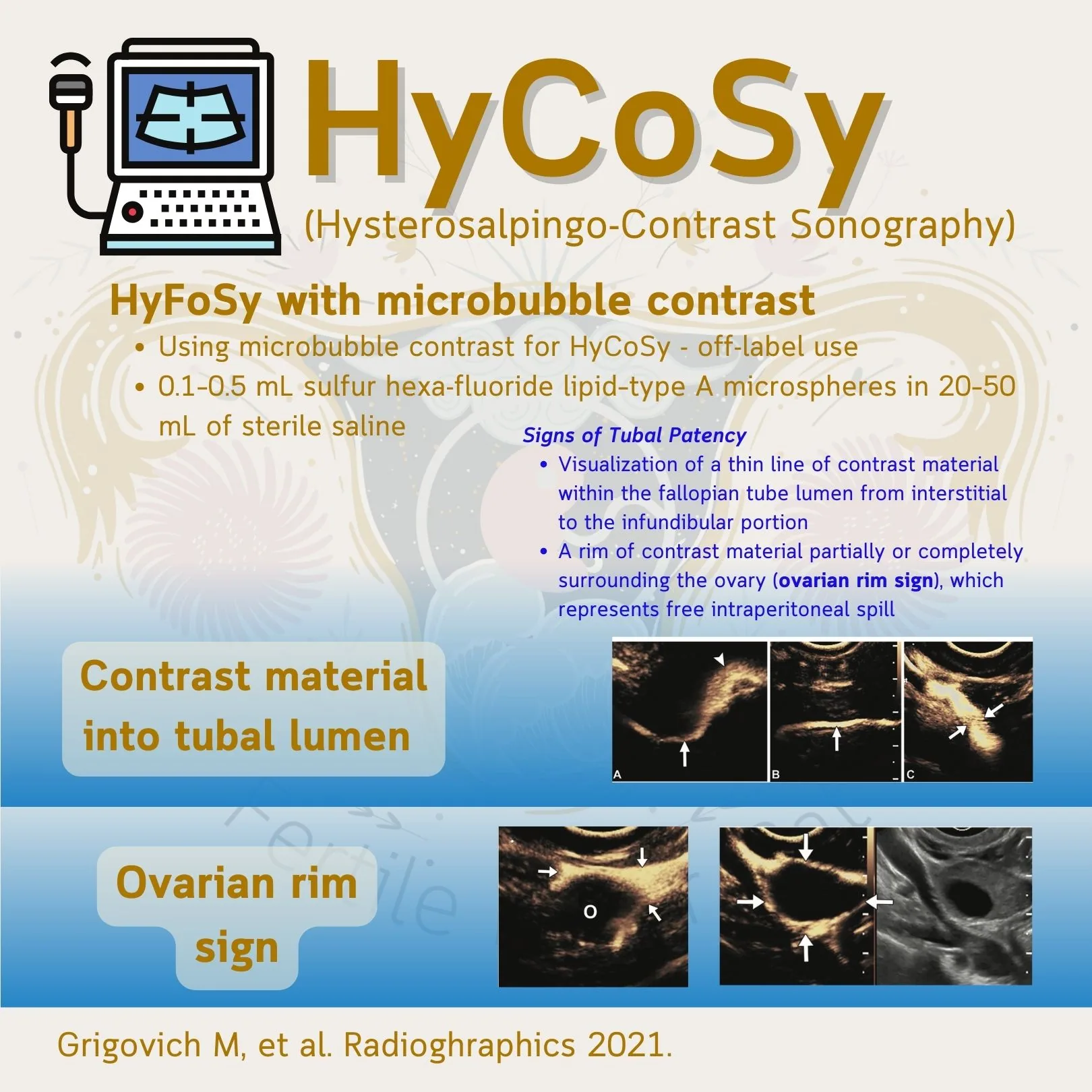 The HyCoSy slide on microbubble contrast (its own heading reads “HyFoSy with microbubble contrast”), showing contrast material in the tubal lumen and the ovarian rim sign (Grigovich M, et al. Radiographics 2021)