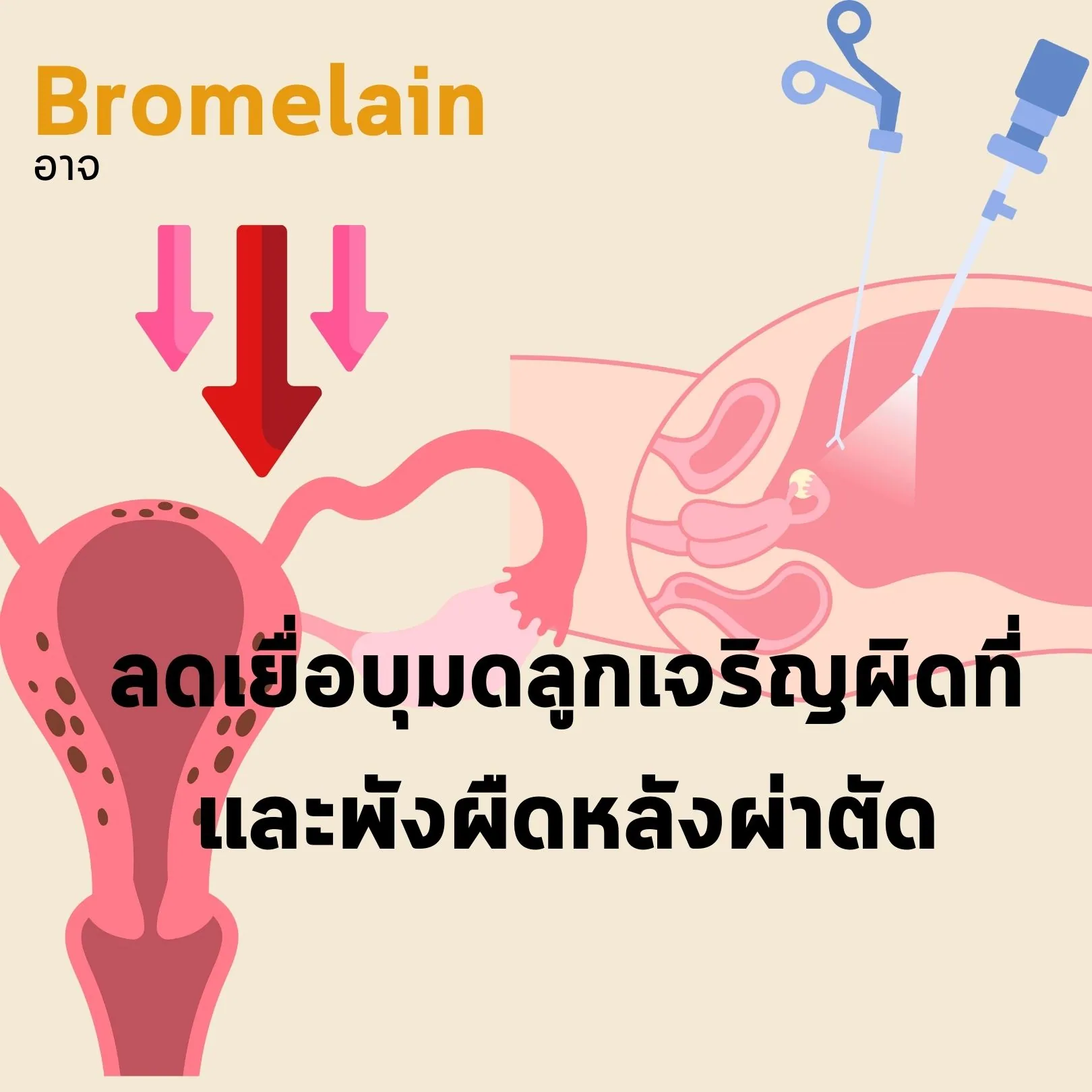 สไลด์ — Bromelain อาจลดเยื่อบุมดลูกเจริญผิดที่ (endometriosis) และพังผืดหลังผ่าตัด ภาพประกอบเป็นมดลูกที่มีรอยโรคกระจายอยู่ และภาพการผ่าตัดผ่านกล้อง