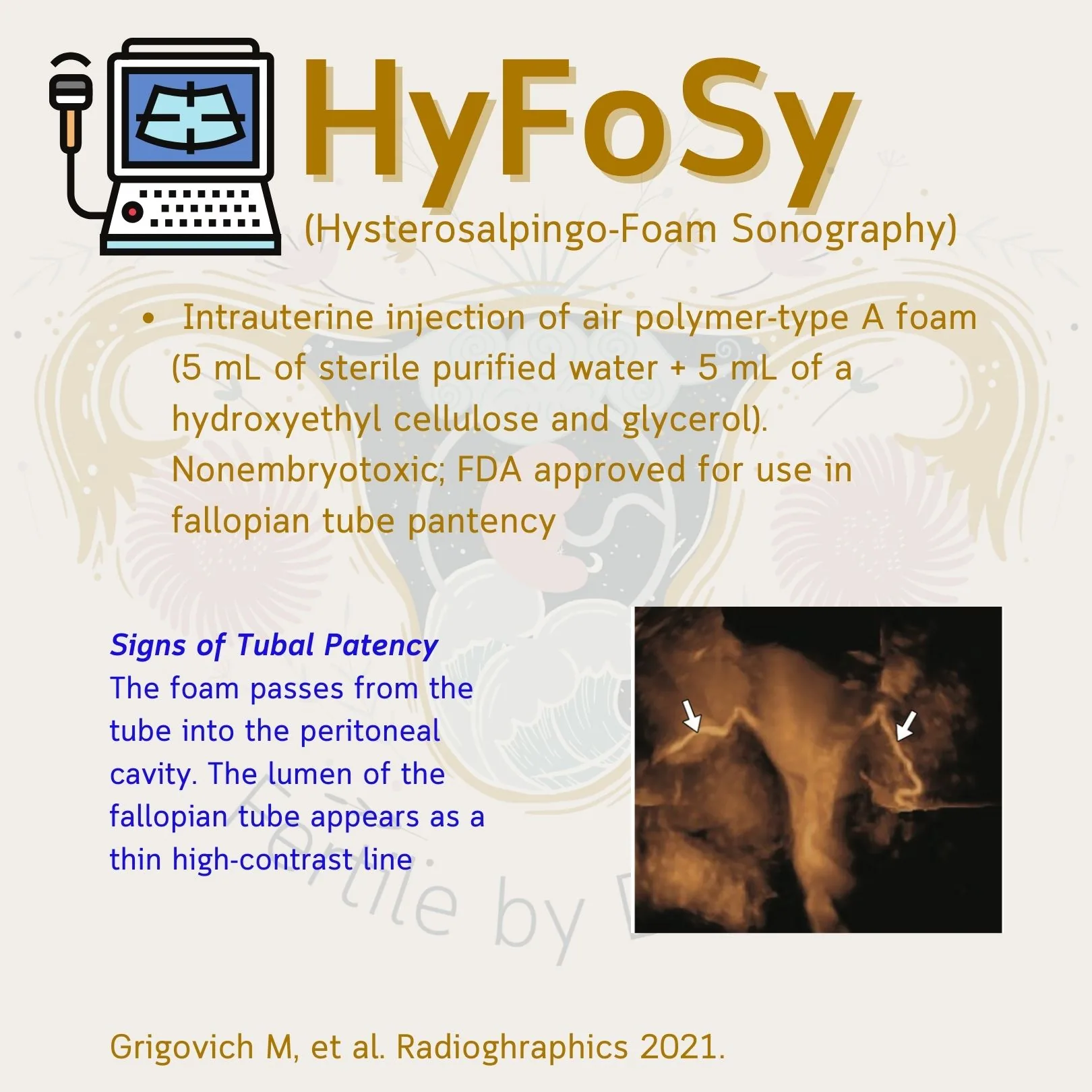 The HyFoSy (hysterosalpingo-foam sonography) slide, with an ultrasound image showing the foam in both fallopian tubes (Grigovich M, et al. Radiographics 2021)